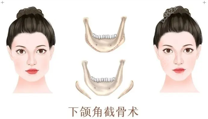 国内下颌角手术医生排名