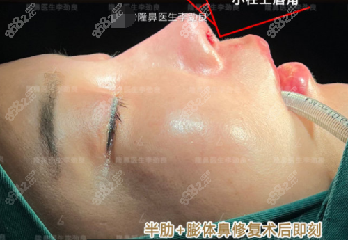 李劲良做鼻子术后即刻