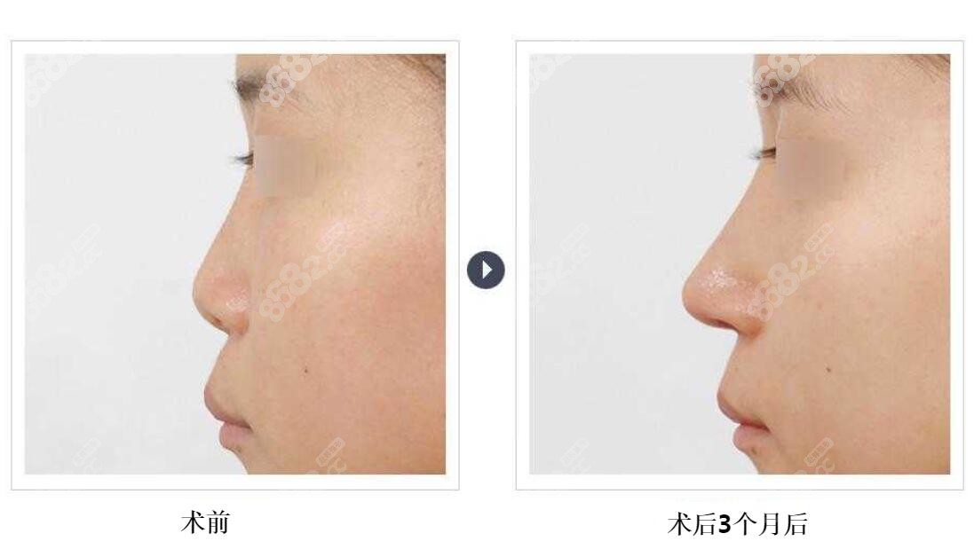韩国gng医院做初鼻前后对比图分享