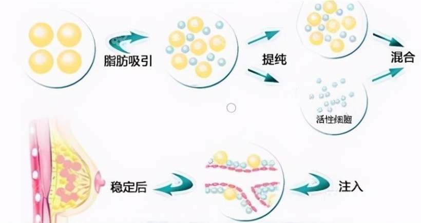 自体脂肪隆胸手术的流程图