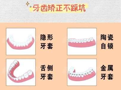 重庆维乐口腔牙齿矫正价格合理m.8682.cc