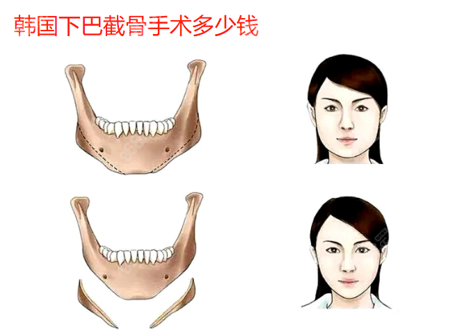 韩国下巴截骨手术多少钱