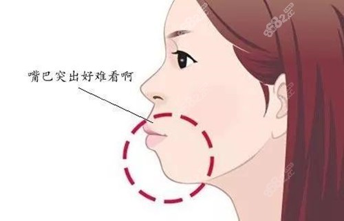 广州骨性凸嘴正颌手术费用多少钱