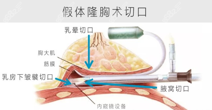 曾昂医生隆胸术怎么样