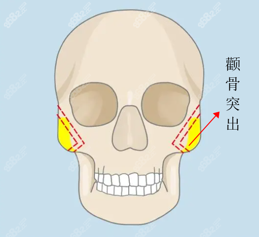 张笑天是国内轮廓手术做得好的医生排名前三名 8682.cc