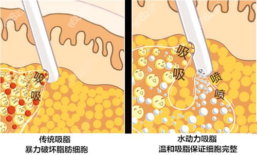 苏州吸脂比较好的医院推荐名单