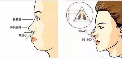 深圳阳光整形罗志敏隆鼻技术