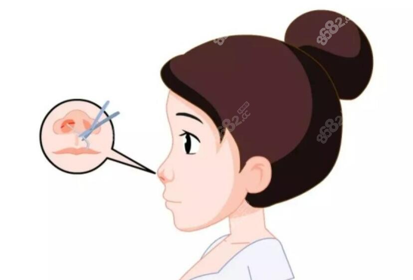隆鼻手术图片