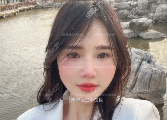 李劲良医生隆鼻术后