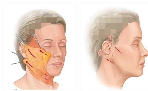 oz皮瓣面部手术图解图片