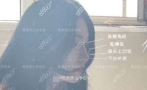 李劲良做鼻子术后各种表现点