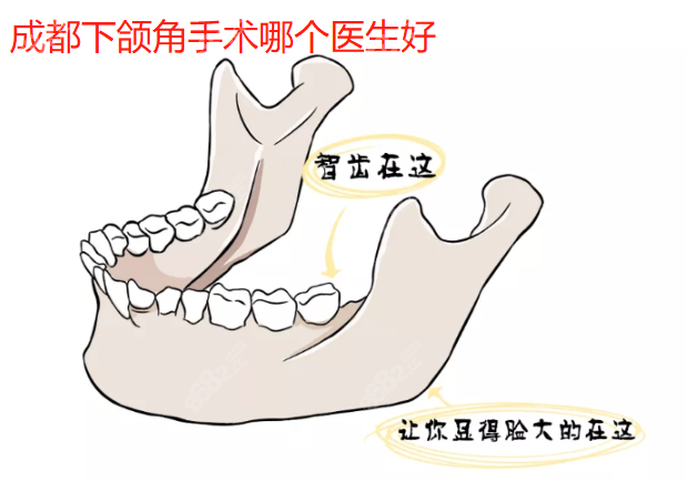 成都下颌角手术哪个医生好