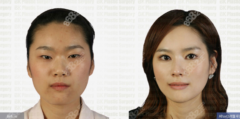 韩国BK整形医院眼部手术价格www.8682.cc