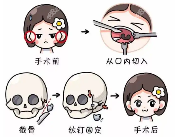 轮廓手术和玻尿酸轮廓固定区别