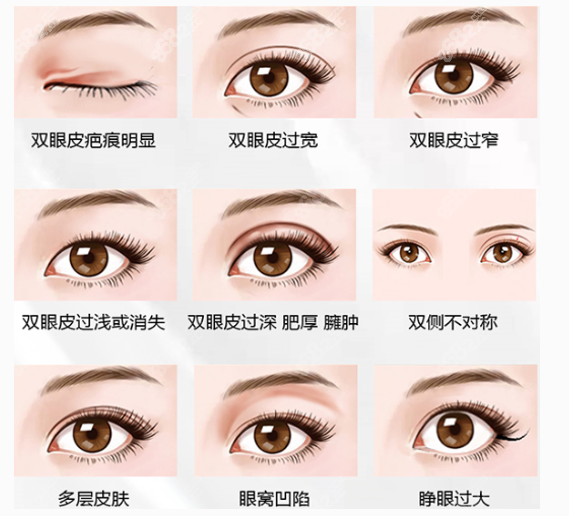 重庆曹阳丽格整形做的双眼皮修复实例分享www.8682.cc