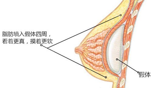 自体脂肪填充和假体丰胸技术相结合