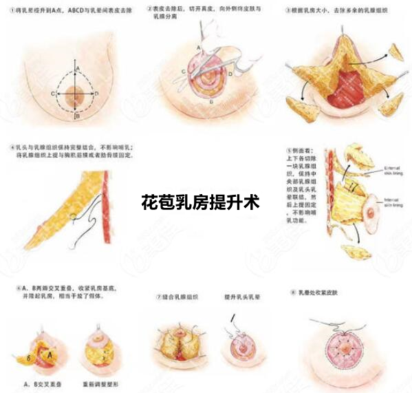 深圳南雅花苞乳房提升术