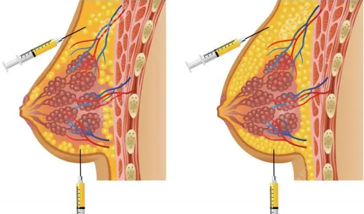 自体脂肪注射丰胸也算是极速丰胸
