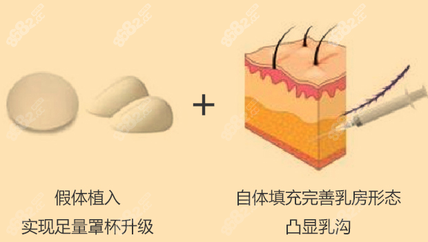 复合隆胸的特点