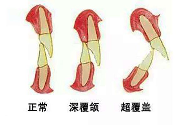 深覆盖分为哪三度