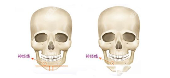 上海出名韩国磨骨医生<!--<i data=20240705-sp></i>-->不错有名（m.8682.cc）