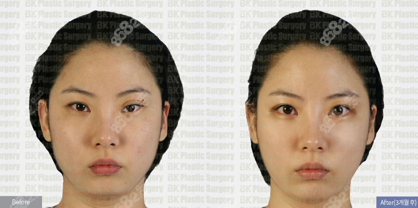 韩国BK眼睛修复手术8682网