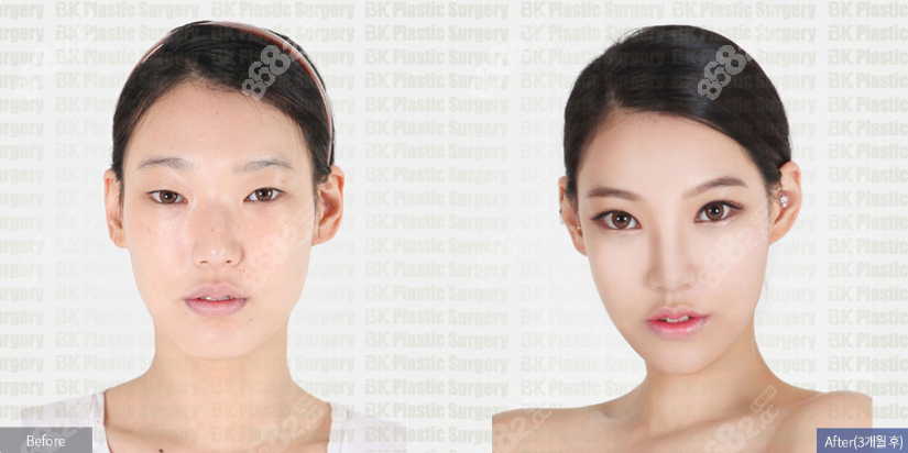韩国BK整形医院双眼皮修复价格