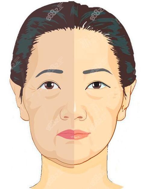 杨大平医生做面部提升能改善大小脸