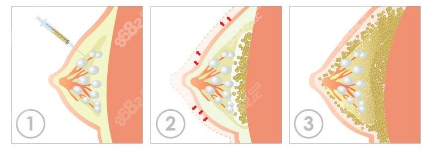 广州自体脂肪隆胸好的医院名单汇总 8682网