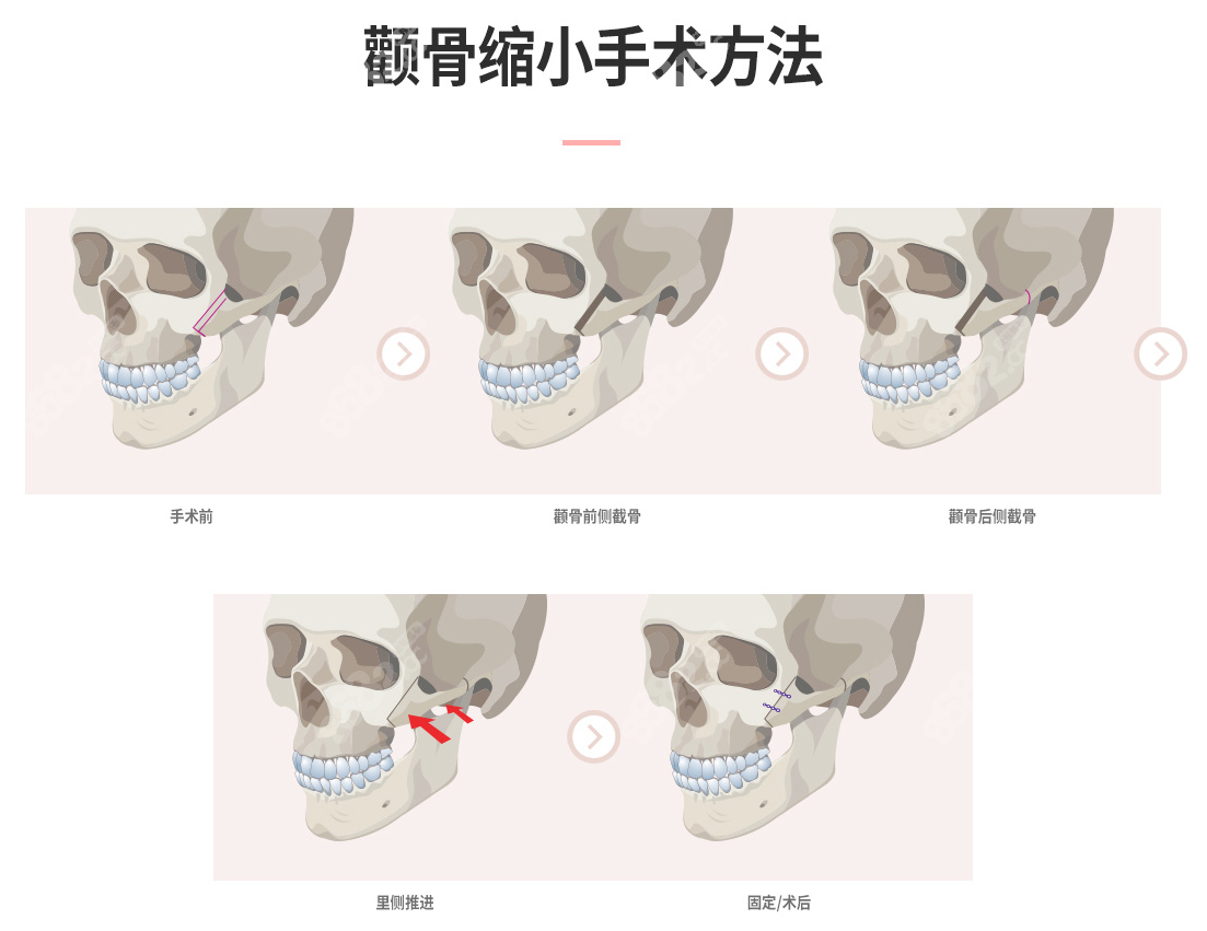 韩国百利酷整形医院颧骨内推手术方法