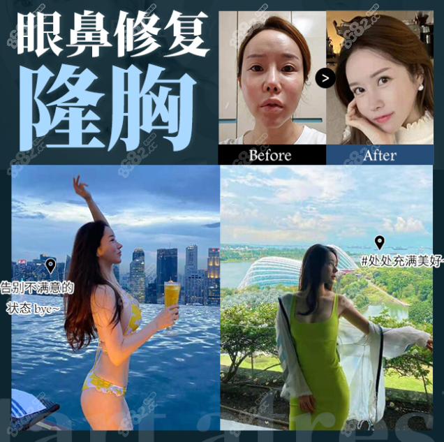 眼鼻修复隆胸真人实例