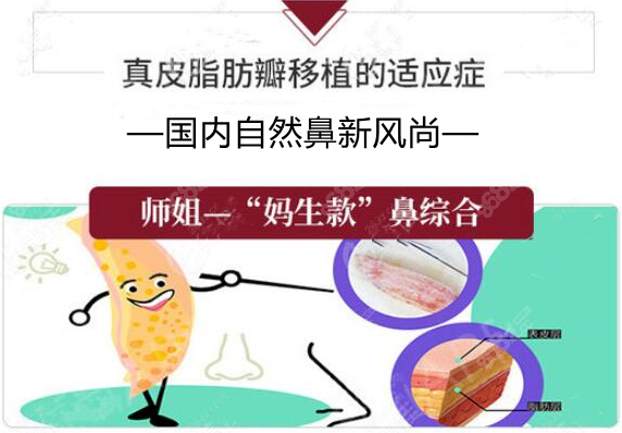 师俊莉真皮瓣+耳软骨隆鼻