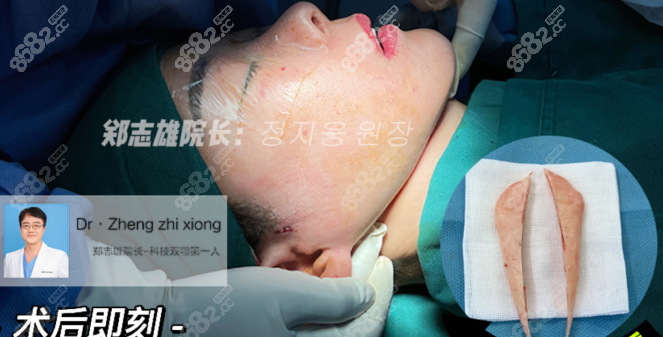 韩国医生郑志雄下颌角手术