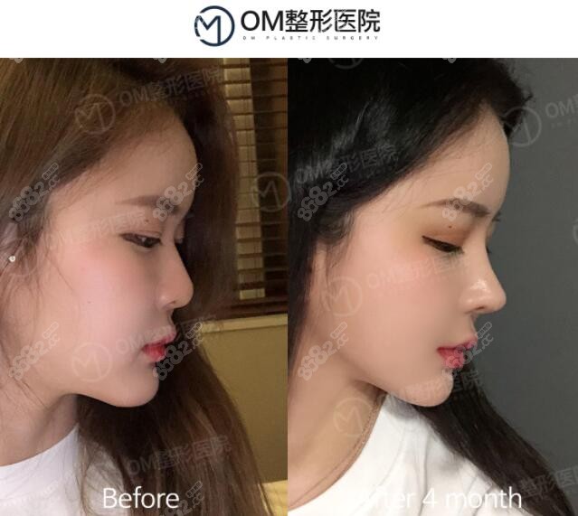 初鼻整形前后对比图