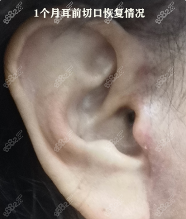 大拉皮术后一个月耳前疤痕几乎看不出