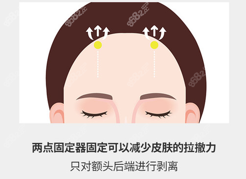 韩国额头缩小手术的方式