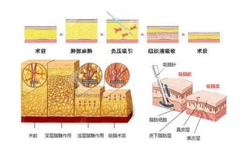 北京画美吸脂技术优势