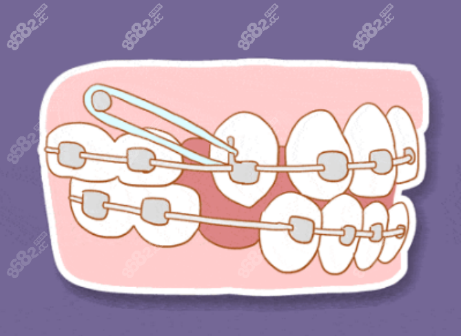 前牙拥挤正畸治疗方案