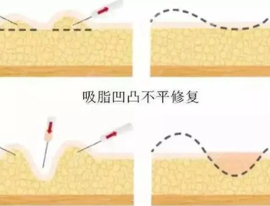 抽脂粘连有哪些症状