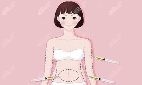 吸脂手术