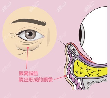 深圳去眼袋手术哪家医院好？深圳做眼袋医院排名名单公布