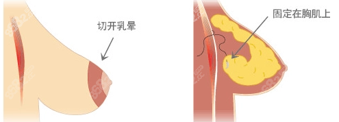 郑州中医药一附院重度乳房下垂矫正手术www.8682.cc