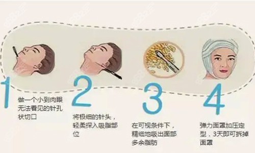 吸脂手术