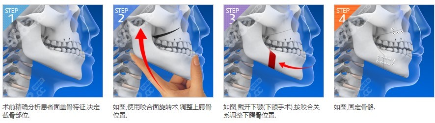 韩国必妩医院双鄂手术过程图解8682.cc分享