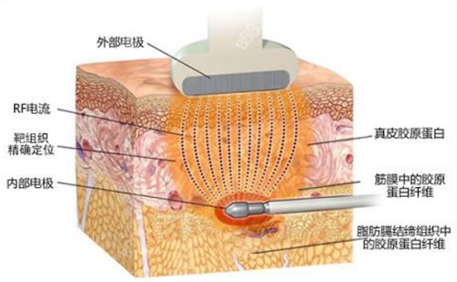 黄金微雕溶脂的原理www.8682.cc