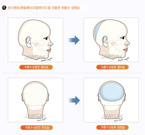 韩国雕刻整形做骨水泥填充手术