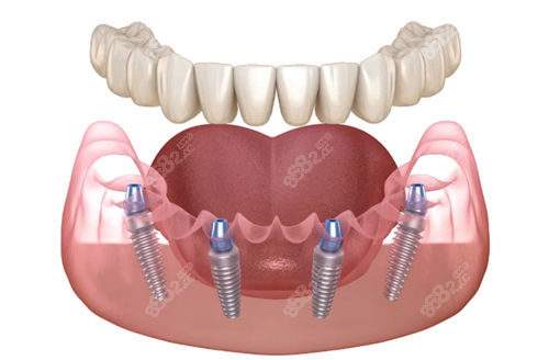 全口种植牙