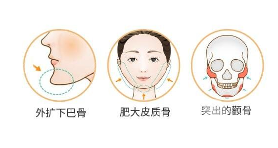 广州改脸型医院哪家好