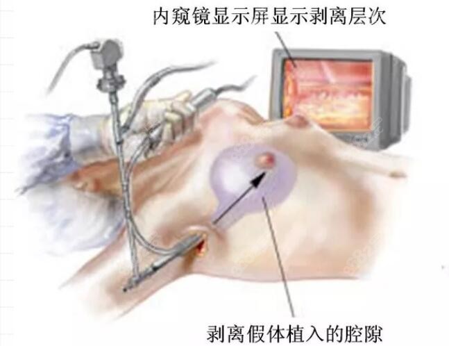 重庆军美哪个医生做隆胸好