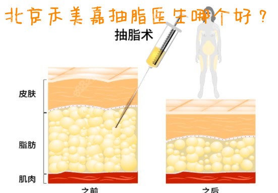 北京禾美嘉抽脂医生哪个好